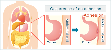 The occurrence of adhesion